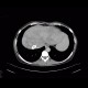 Budd-Chiari syndrome, thrombosis of hepatic veins, liver cirrhosis, TIPSS, splenomegally: CT - Computed tomography